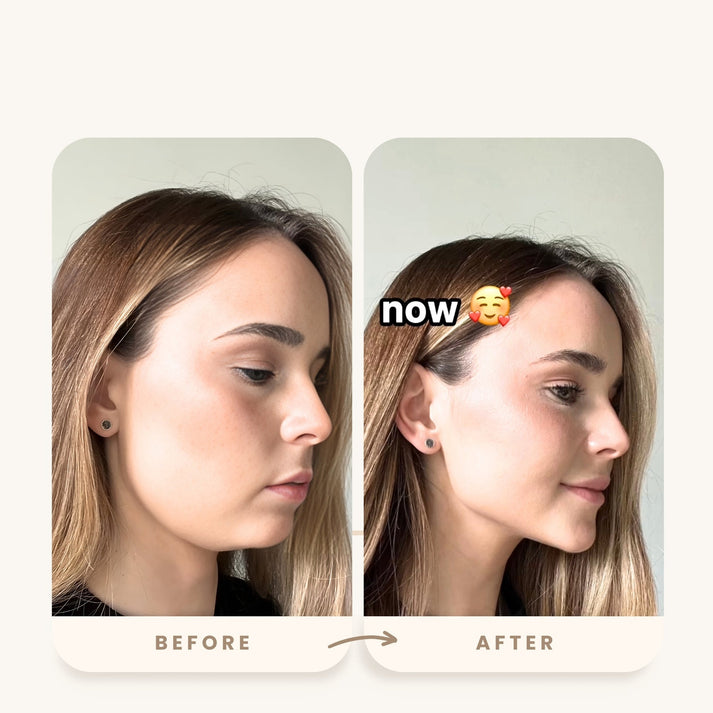Neck and Face Lifter Device - LunaLift™
